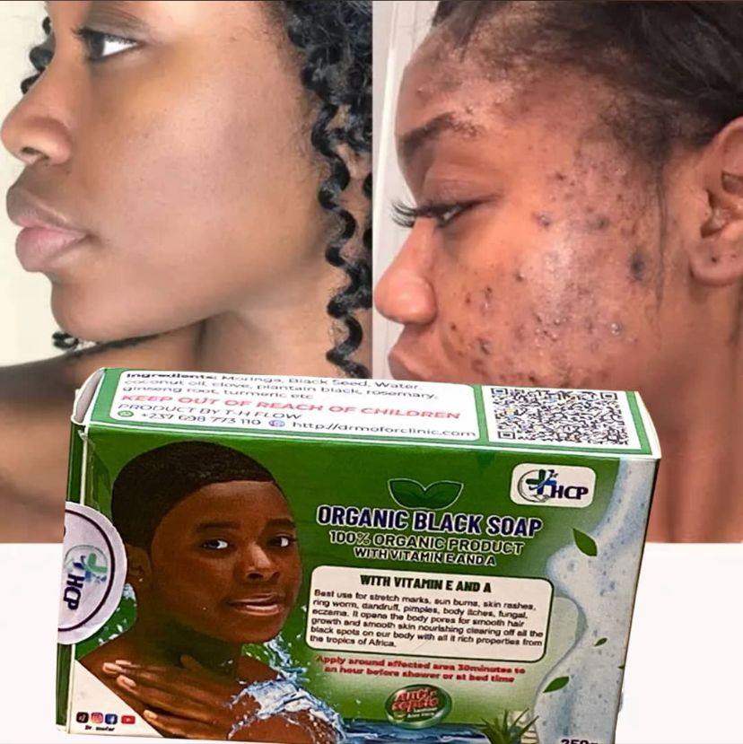 Organic Black Soap packaging with before/after results